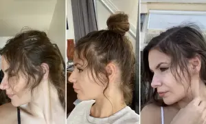 Trois vues de profil d'une femme montrant une perte de cheveux sur le devant, avec des petits cheveux devant qui ne poussent pas.
