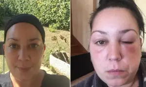 Comparaison avant/après : visage normal puis visage gonflé, œil fermé. Une allergie coloration combien de temps après peut causer un tel gonflement.
