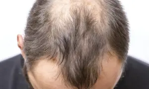 Vue rapprochée du sommet de la tête d'un homme montrant une calvitie avancée, possiblement liée à la perte de cheveux stress.