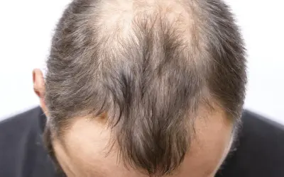 Vue rapprochée du sommet de la tête d'un homme montrant une calvitie avancée, possiblement liée à la perte de cheveux stress.