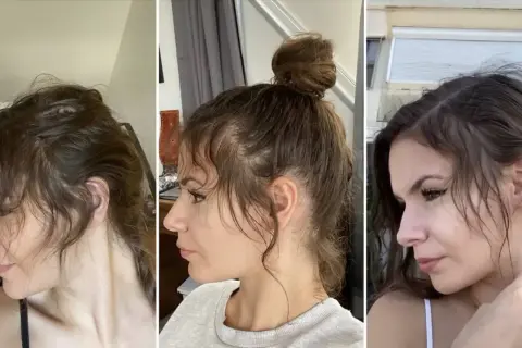 Trois vues de profil d'une femme montrant une perte de cheveux sur le devant, avec des petits cheveux devant qui ne poussent pas.