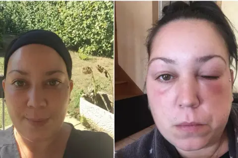 Comparaison avant/après : visage normal puis visage gonflé, œil fermé. Une allergie coloration combien de temps après peut causer un tel gonflement.