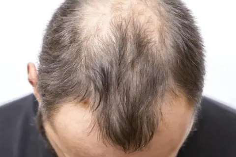 Vue rapprochée du sommet de la tête d'un homme montrant une calvitie avancée, possiblement liée à la perte de cheveux stress.