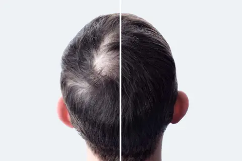 Comparaison avant/après : le côté gauche montre des cheveux clairsemés, le côté droit une chevelure plus dense.