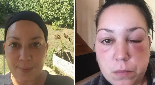 Comparaison avant/après : visage normal puis visage gonflé, œil fermé. Une allergie coloration combien de temps après peut causer un tel gonflement.