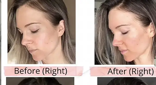 Avant/après : le visage et la ligne frontale d'une femme. Le traitement semble favoriser la pousse des cheveux.
