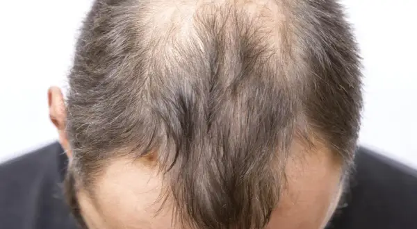 Vue rapprochée du sommet de la tête d'un homme montrant une calvitie avancée, possiblement liée à la perte de cheveux stress.