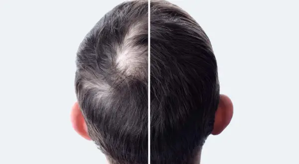 Comparaison avant/après : le côté gauche montre des cheveux clairsemés, le côté droit une chevelure plus dense.