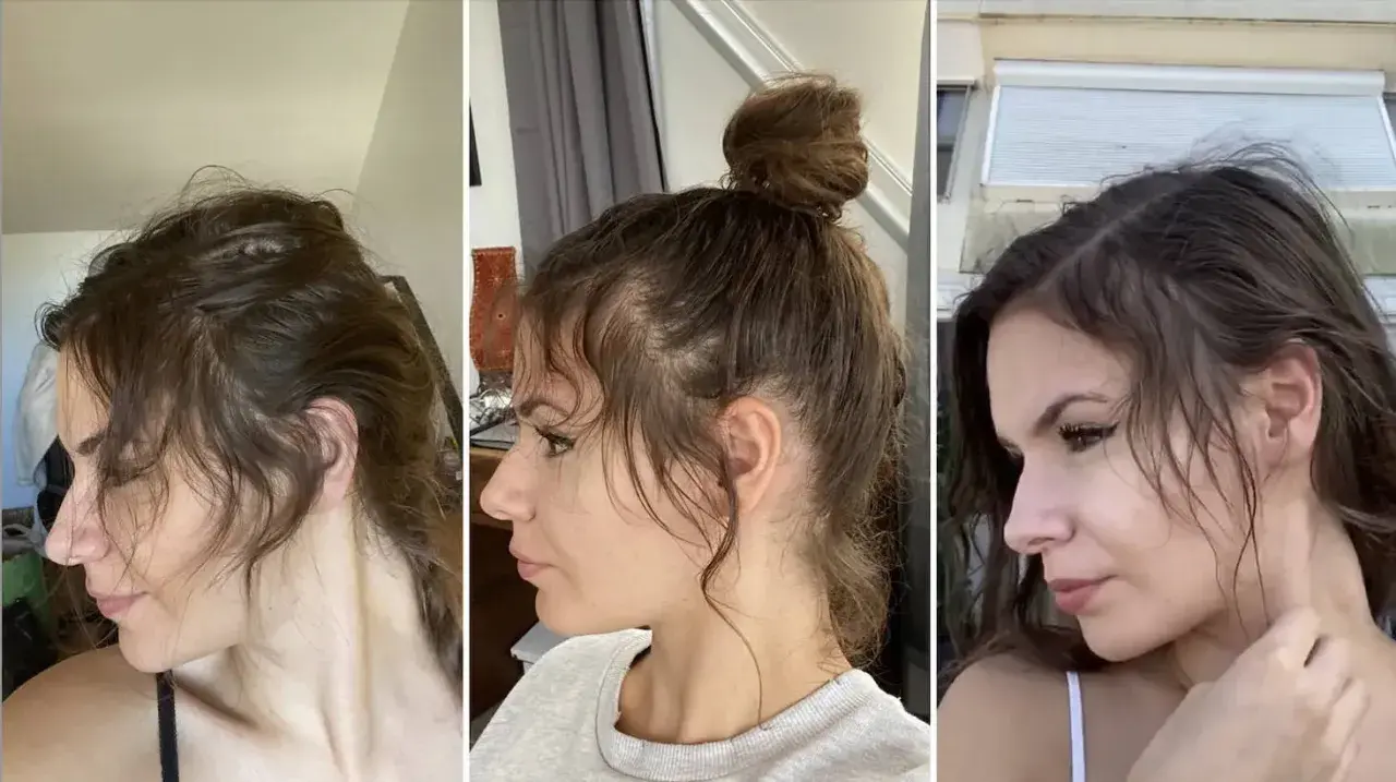 Trois vues de profil d'une femme montrant une perte de cheveux sur le devant, avec des petits cheveux devant qui ne poussent pas.