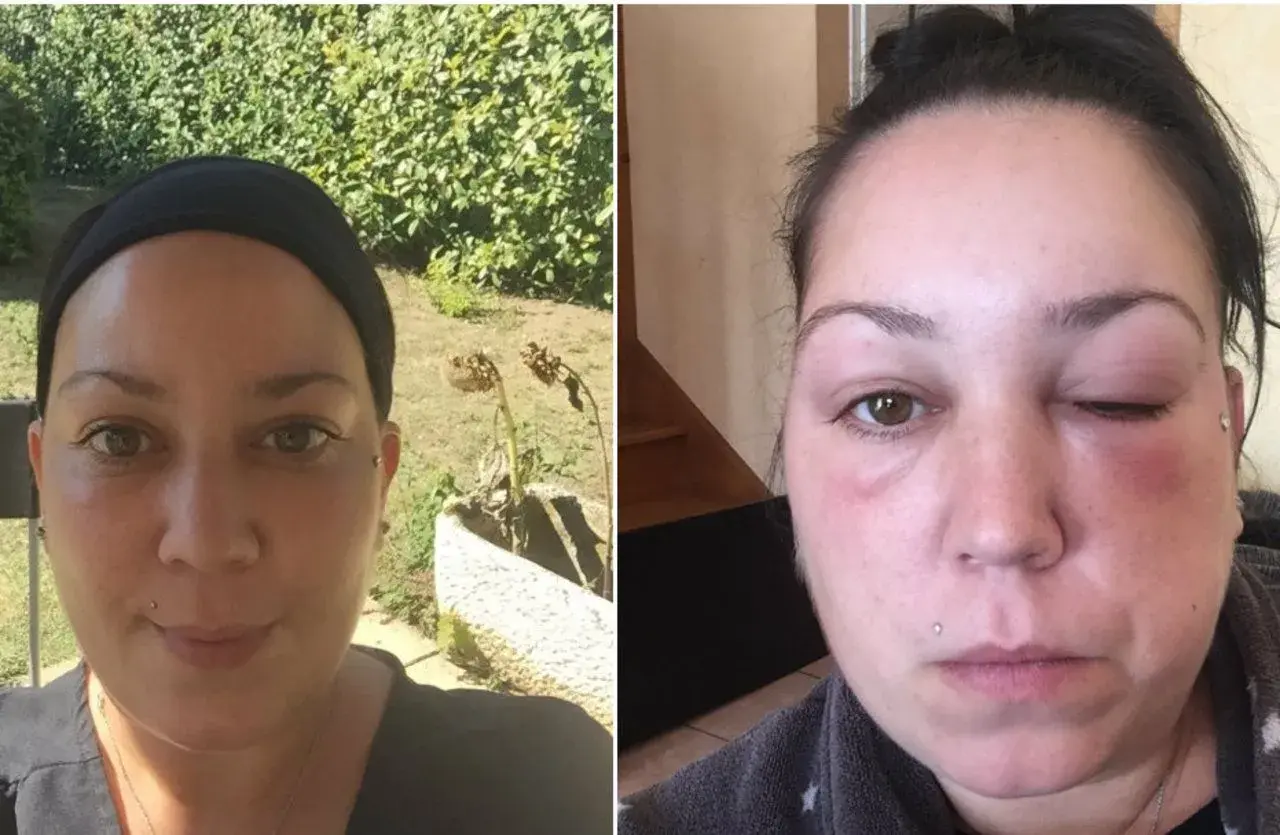 Comparaison avant/après : visage normal puis visage gonflé, œil fermé. Une allergie coloration combien de temps après peut causer un tel gonflement.