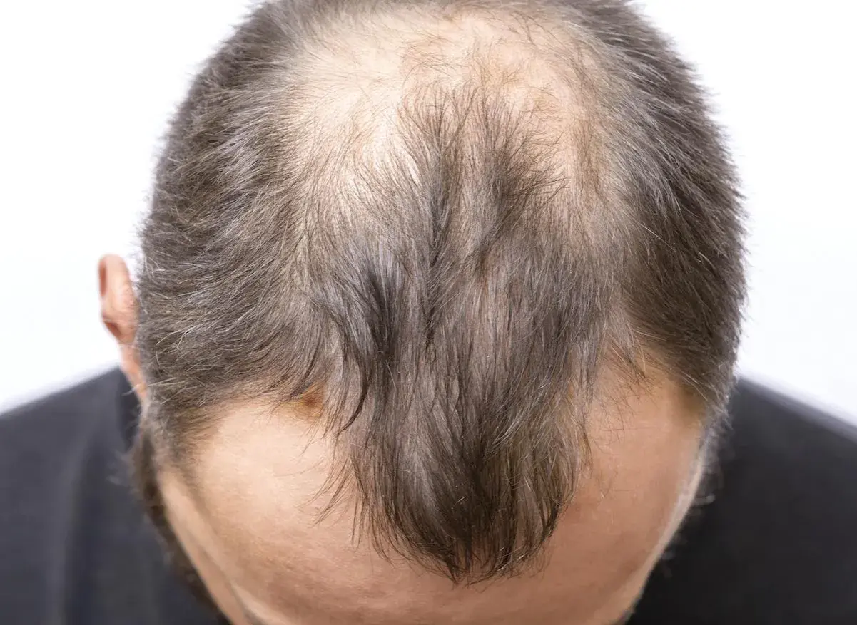 Vue rapprochée du sommet de la tête d'un homme montrant une calvitie avancée, possiblement liée à la perte de cheveux stress.