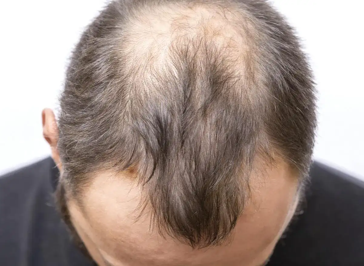 Vue rapprochée du sommet de la tête d'un homme montrant une calvitie avancée, possiblement liée à la perte de cheveux stress.
