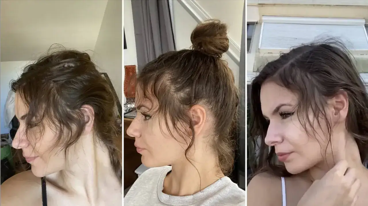 Trois portraits de profil d'une jeune femme montrant une perte de cheveux sur les tempes. Elle semble pr&eacute;occup&eacute;e, car mes cheveux ne poussent plus.