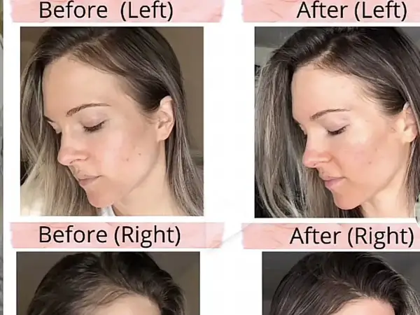 Avant/après : le visage et la ligne frontale d'une femme. Le traitement semble favoriser la pousse des cheveux.